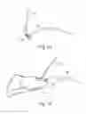 Fig. 06 - Device for the delivery of a prosthetic implant and method of use thereof