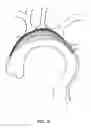 Fig. 09 - CATHETER-BASED APPARATUSES AND METHODS