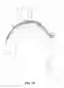 Fig. 10 - CATHETER-BASED APPARATUSES AND METHODS