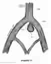 Fig. 13 - Medical device