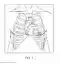 Fig. 02 - DIRECT AORTIC ACCESS SYSTEM FOR TRANSCATHETER AORTIC VALVE PROCEDURES