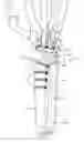 Fig. 02 - Prosthesis including ball and socket arrangement