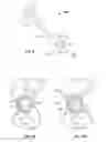 Fig. 04 - PATIENT-SPECIFIC ACETABULAR ALIGNMENT GUIDES