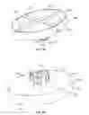 Fig. 09 - PATIENT-SPECIFIC ACETABULAR ALIGNMENT GUIDES