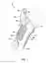 Fig. 02 - Thumb Rehabilitation Splinting Device