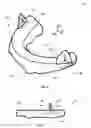 Fig. 05 - Occlusal splint arrangement