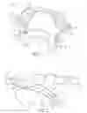 Fig. 02 - Oral device for preventing sleep apnea and a method of manufacturing