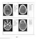 Fig. 06 - Composition containing carboplatin and use