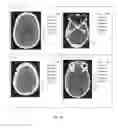 Fig. 07 - Composition containing carboplatin and use