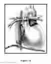 Fig. 35 - Methods of improving myocardial performance in Fontan patients using udenafil compositions