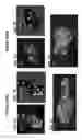 Fig. 08 - OXYGENATED DEMINERALIZED BONE MATRIX FOR USE IN BONE GROWTH