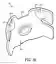 Fig. 14 - Passive nose bridge pressure distributing insert
