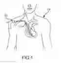 Fig. 02 - Surgical instrument for removing an implanted object