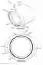 Fig. 35 - Surgical instrument for removing an implanted object