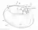 Fig. 01 - Implantable medical device with locking datum arrangement between DF4/IS4 assembly and header