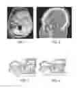 Fig. 02 - LOW PROFILE ARTICULATION JAW JOINT STABILIZER DEVICE