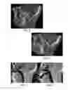 Fig. 03 - LOW PROFILE ARTICULATION JAW JOINT STABILIZER DEVICE