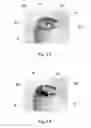 Fig. 08 - CONSTRUCTIVE ARRANGEMENT APPLIED TO A SEAL IN A BEVERAGE PACKAGE