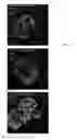 Fig. 10 - Genetically Modified IPS Cells That Carry a Marker to Report Expression of Neurogenin3, TPH2, FOXO1 and/or Insulin Genes