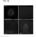 Fig. 03 - Use of phospholipid scramblase inhibitors for modulating inflammatory immune responses