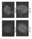 Fig. 07 - ENGINEERED MODEL OF FIBROTIC DISEASES