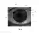 Fig. 09 - Methods and apparatuses for determining contact lens intolerance in contact lens wearer patients based on dry eye tear film characteristic analysis and dry eye symptoms