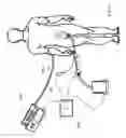 Fig. 31 - Systems, devices and methods for sensing physiologic data and draining and analyzing bodily fluids