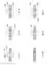 Fig. 35 - Systems, devices and methods for sensing physiologic data and draining and analyzing bodily fluids