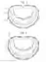 Fig. 02 - Suture fastener having spaced-apart layers