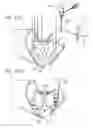 Fig. 12 - Suture fastener having spaced-apart layers