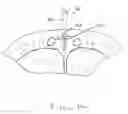 Fig. 10 - Devices and methods for reshaping blood vessels