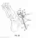 Fig. 46 - Ankle replacement system and method