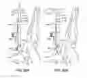 Fig. 80 - Ankle replacement system and method