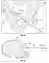 Fig. 05 - Internal pelvic fixator