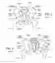 Fig. 06 - Implants for spinal fixation or fusion