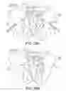 Fig. 16 - Implants for spinal fixation or fusion