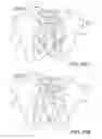 Fig. 17 - Implants for spinal fixation or fusion
