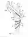 Fig. 06 - Device for fixation of bone fragments