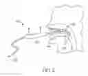 Fig. 07 - Soft palate treatment