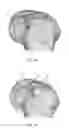 Fig. 09 - SYSTEM AND METHOD FOR OPTIMIZING AN IMPLANT POSITION IN AN ANATOMICAL JOINT