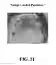 Fig. 52 - System and method for the design, creation and installation of implant-supported dental prostheses