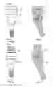 Fig. 16 - Fixed hybrid dental attachment assembly and methods of use