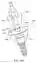 Fig. 41 - DENTAL IMPLANT SYSTEM