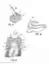 Fig. 03 - One step gingiva retraction and impression material and method