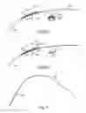 Fig. 08 - Intravascular devices and delivery systems and uses thereof