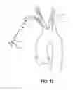 Fig. 13 - Intravascular blood filter