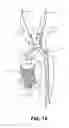 Fig. 15 - Intravascular blood filter