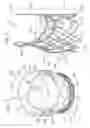 Fig. 05 - Low-profile heart valve and delivery system