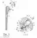Fig. 02 - Method of implanting joint prosthesis with infinitely positionable head