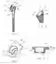 Fig. 04 - Method of implanting joint prosthesis with infinitely positionable head